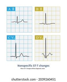 T Wave Inversion Images Stock Photos Vectors Shutterstock