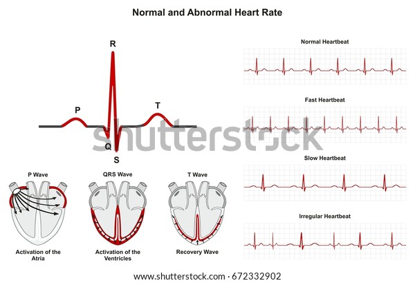 Normal Abnormal Heart Rate Infographic Diagram Stock Illustration