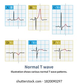 Normal Abnormal T Wave Forms Intertwined Stock Illustration 1820090297 ...