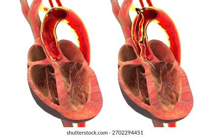 Normal aorta compared with aortic dissection, 3D illustration. Dissection involves wall tear and false lumen, a life-threatening emergency requiring rapid diagnosis and treatment.
