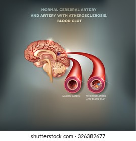 Normal Cerebral Artery And Artery With Atherosclerosis And Blood Clot.  Blocked Blood Flow By The Thrombus. Beautiful Mesh Abstract Background