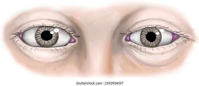 dilated pupils vs normal