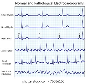 258 Atrial flutter Images, Stock Photos & Vectors | Shutterstock