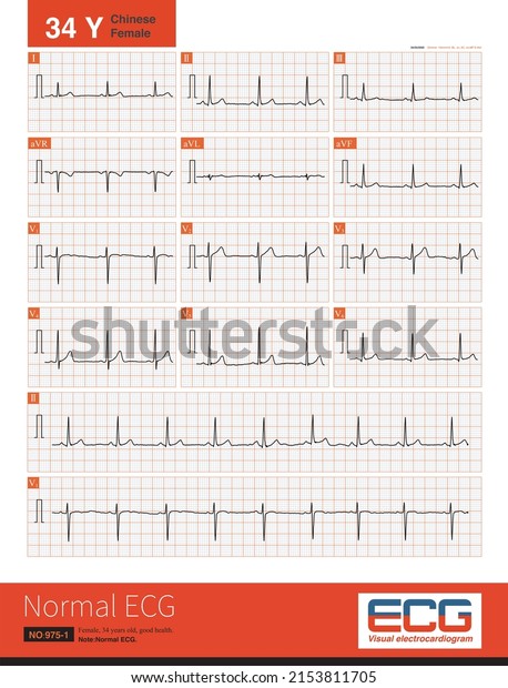 Normal Electrocardiogram 34 Year Old Chinese Stock Illustration ...