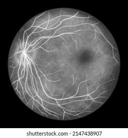 Normal Eye Retina, Scientific Illustration Showing Optic Disk, Blood Vessels, Macula And Fovea, Ophthalmoscope View, Fluorescein Angiography