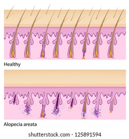 Normal Hair And Alopecia Areata