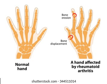 15,836 Rheumatoid arthritis pain Images, Stock Photos & Vectors ...