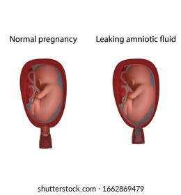 Normal Leaking Amniotic Fluid Cervical Weakness Stock Illustration