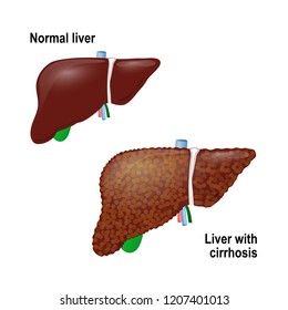 Normal Liver Liver Cirrhosis Cirrhosis Condition Stock Illustration ...