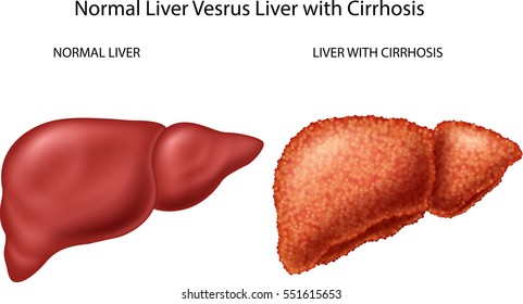 Cirrhosis Images, Stock Photos & Vectors | Shutterstock