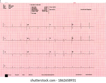 A Normal Resting ECG Report Of A Patient. Echocardiogram Report Of A 67 Years Male Patient.