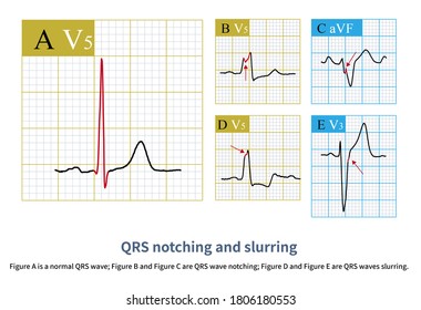 899 Qrs Wave Images, Stock Photos & Vectors | Shutterstock