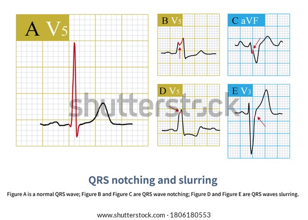 Normal Ventricular Depolarization Produces Smooth Sharp Stock ...