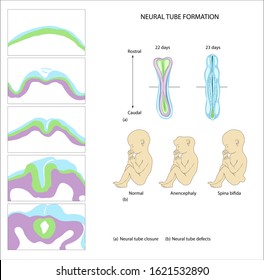 Nutrition And The Neural Tube. Neural Tube Formation.  Anencephaly. Folic Acid. Biosynthesis Of DNA. Planning Pregnancy. Neural Tube Disease.  Birth Defect