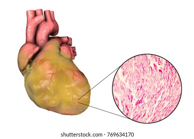 Obese Heart With Left Ventricular Hypertrophy, 3D Illustration And Micrograph