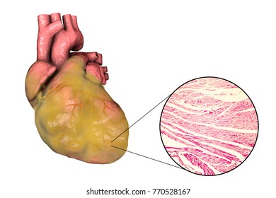 Obese Heart With Left Ventricular Hypertrophy, 3D Illustration And Micrograph