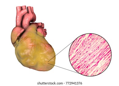 Obese Heart With Left Ventricular Hypertrophy, 3D Illustration And Micrograph