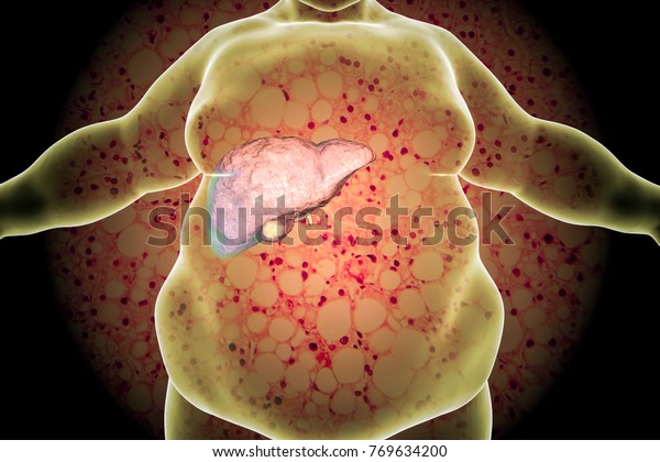 肝不全症の顕微鏡写真と脂肪肝を持つ肥満の男性 3dイラスト ノンアルコール性脂肪肝疾患のコンセプト画像 のイラスト素材