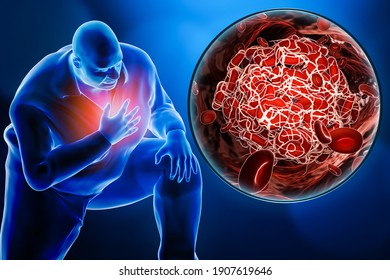 Obese Or Overweight Man Suffering A Heart Attack Or A Pulmonary Embolism With A Close-up Image Of A Blood Clot 3D Rendering Illustration. Medicine, Medical Condition, Pathology, Health Concepts.