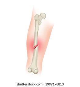 Oblique Compound Bone Fracture. Femoral Shaft Fracture