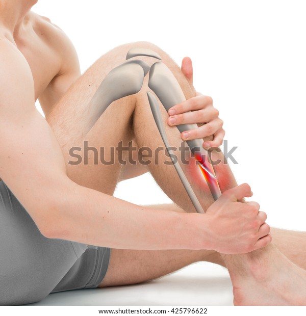 Oblique Fracture of the Tibia - Leg Hurt\
Anatomy - 3D\
illustration