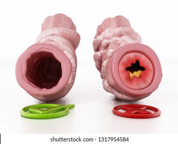 Obstructed And Unobstructed Bronchial Tubes Representing Asthma. 3D Illustration.