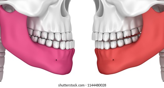 Occlusion: Overjet And Overbite, 3D Illustration .