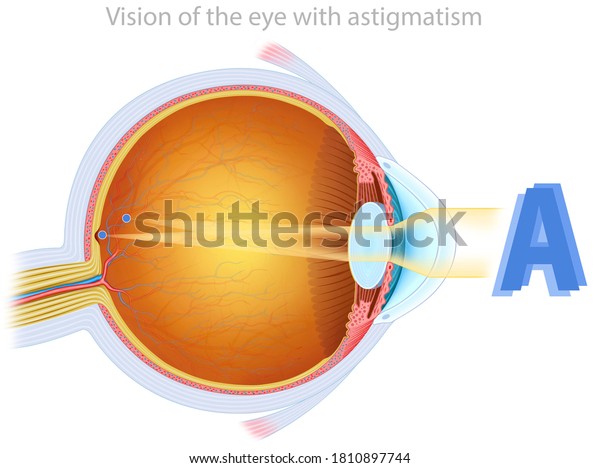 Ocular astigmatism,\
anatomical and descriptive illustration of the human eye where\
pronounced curvature of the cornea is seen, this causes difficulty\
in focusing on\
objects.