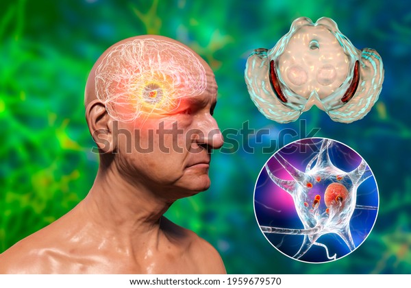 An old man with Parkinson\'s disease and\
highlighted black substance of the midbrain. 3D illustration shows\
decrease of substantia volume and accumulation of Lewy bodies in\
its dopaminergic\
neurons