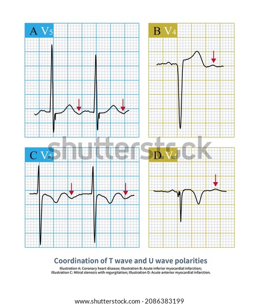 On Ecg When Polarity T Wave Stock Illustration 2086383199 | Shutterstock