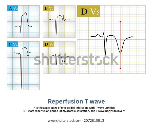 Once Acute Transmural Myocardial Infarction Begins Stock Illustration ...