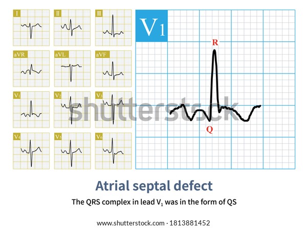 Once Qs Wave Appears Lead V1 Stock Illustration 1813881452 | Shutterstock