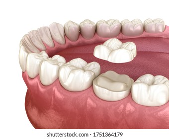 Onlay Ceramic Crown Fixation Over Molar Tooth. Medically Accurate 3D Illustration Of Human Teeth Treatment