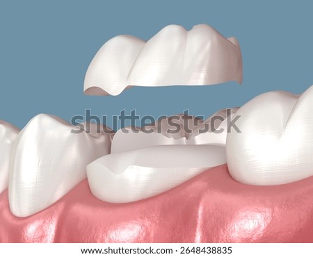 Onlay ceramic crown placement. Medically accurate 3D illustration