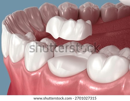 Onlay ceramic crown placement. Medically accurate 3D illustration