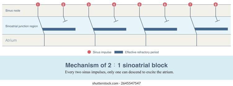 Only one of every two impulses generated by sinoatrial node can be transmitted to atrium, resulting in sinus P wave, and the other one is blocked, which is called 2:1 sinoatrial block.
