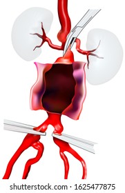 Open surgery for Abdominal Aortic Aneurysm (AAA) located below the arteries  that supply blood to the kidneys. Aorta are opened, before insert  a graft. 3D illustration.