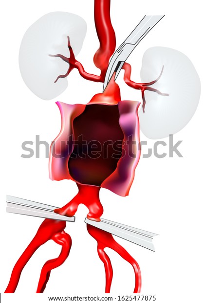 Open Surgery For Abdominal Aortic Aneurysm AAA Located Below The 