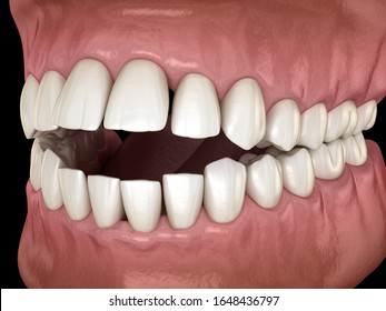 Openbite Dental Occlusion ( Malocclusion Of Teeth ). Medically Accurate Tooth 3D Illustration