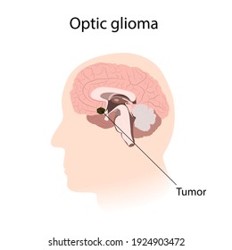 Optic Glioma. Brain Cancer, Tumor With Explanations.