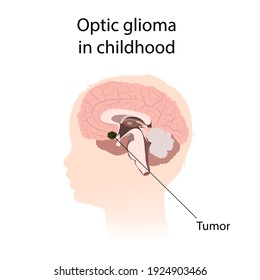 Optic glioma in childhood. Brain cancer, tumor with explanations.