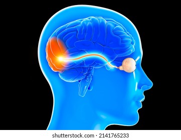 Optic Nerve, Section Of The Brain Seen From The Side. Nerve Injury. Poor Eyesight. Optic Neuritis. Inflammation, Partial Or Total Loss Of Vision, 3d Rendering