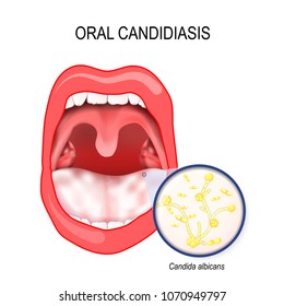 Oral Candidiasis. Oral Thrush That Occurs In The Mouth. Mycosis (yeast Infection) Of Fungal Candida Albicans On The Mucous Membranes Of The Mouth.