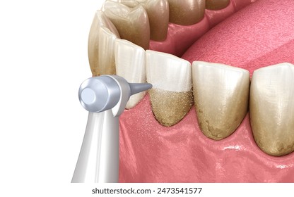 Oral hygiene: Air flow water Teeth Cleaning. Medically accurate 3D installation of human teeth treatment - Powered by Shutterstock