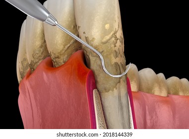 Oral hygiene: Scaling and root planing of Periodontitis stage 3 (conventional periodontal therapy). Medically accurate 3D illustration of human teeth treatment