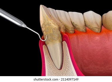 Oral hygiene: Scaling and root planing (conventional periodontal therapy). Medically accurate 3D illustration of human teeth treatment