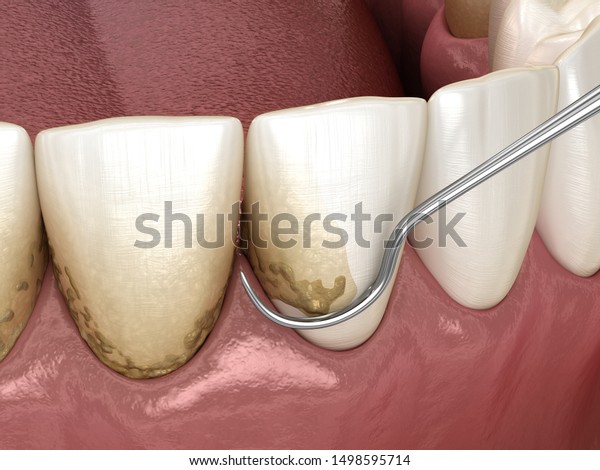 Oral Hygiene Scaling Root Planing Conventional Stock Illustration 1498595714 4865