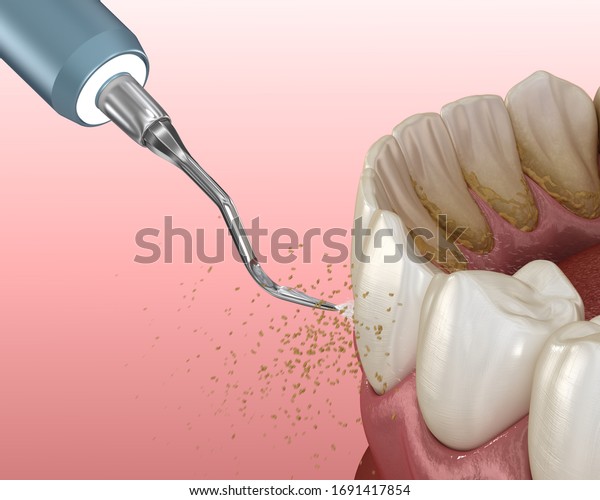 Oral Hygiene Scaling Root Planing Conventional Stock Illustration 1691417854 Shutterstock 8812