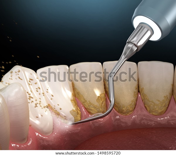 Oral Hygiene Ultrasonic Teeth Cleaning 600w 1498595720 