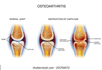 Osteoarthritis, Destruction Of Cartilage. Healthy Joint And Unhealthy Joint Anatomy.